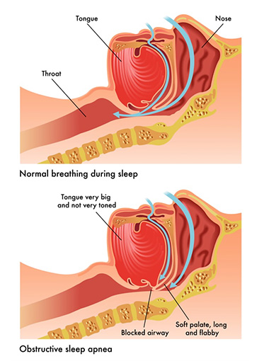 sleepapnea